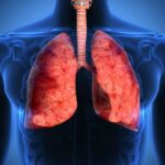 Tumore del polmone, speranze da nuovo farmaco a bersaglio molecolare