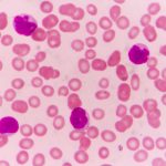 Tumori del sangue: Covid più cattivo in chi sospende le cure oncologiche