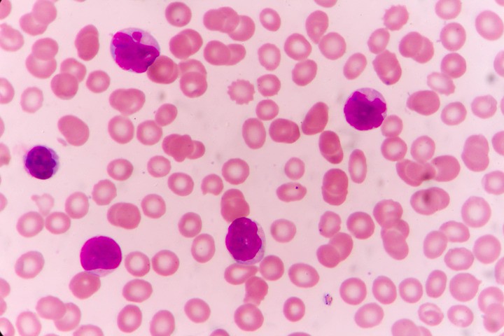 Tumori del sangue: Covid più cattivo in chi sospende le cure oncologiche